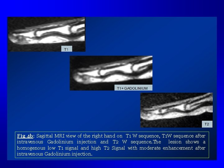 Fig 4 b: Sagittal MRI view of the right hand on T 1 W