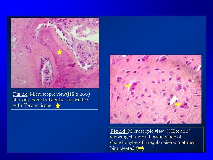 Fig 4 c: Microscopic view(HE x 200) showing bone trabeculae associated with fibrous tissue