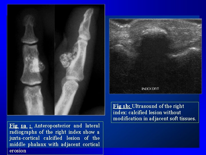 Fig 1 b: Ultrasound of the right index: calcified lesion without modification in adjacent