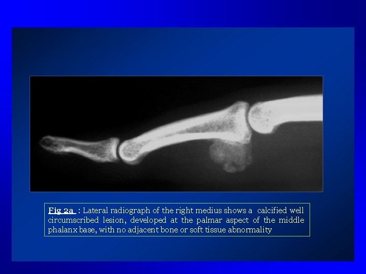 Fig 2 a : Lateral radiograph of the right medius shows a calcified well