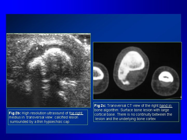 Fig 2 b: High resolution ultrasound of the right medius in transversal view: calcified