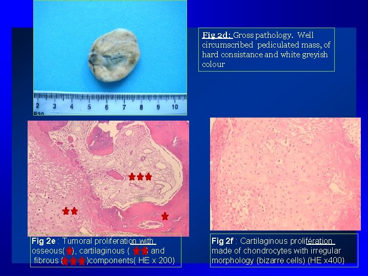 Fig 2 d: Gross pathology. Well circumscribed pediculated mass, of hard consistance and white