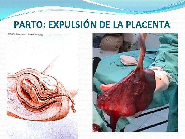 PARTO: EXPULSIÓN DE LA PLACENTA 