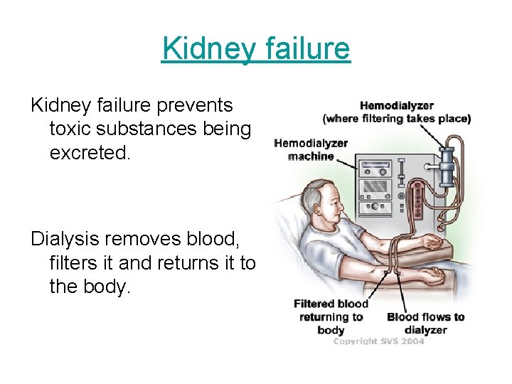 Kidney failure prevents toxic substances being excreted. Dialysis removes blood, filters it and returns