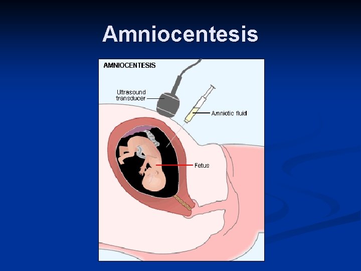 Amniocentesis 