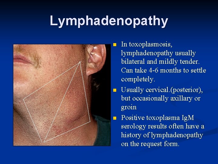 Lymphadenopathy n n n In toxoplasmosis, lymphadenopathy usually bilateral and mildly tender. Can take