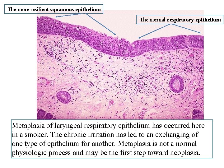 The more resilient squamous epithelium The normal respiratory epithelium Metaplasia of laryngeal respiratory epithelium