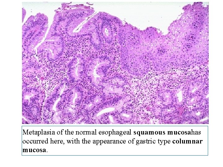 Metaplasia of the normal esophageal squamous mucosahas occurred here, with the appearance of gastric