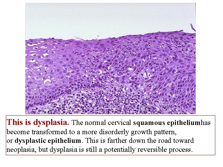 This is dysplasia. The normal cervical squamous epitheliumhas become transformed to a more disorderly