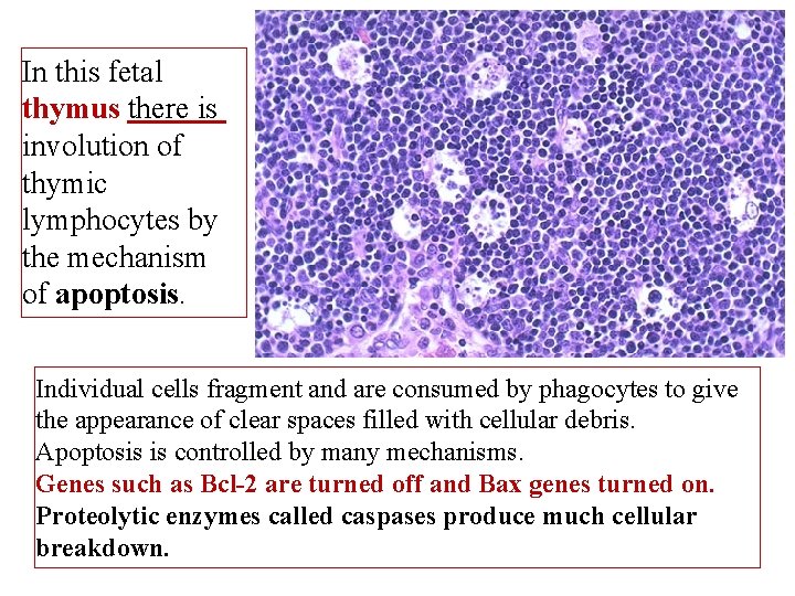In this fetal thymus there is involution of thymic lymphocytes by the mechanism of