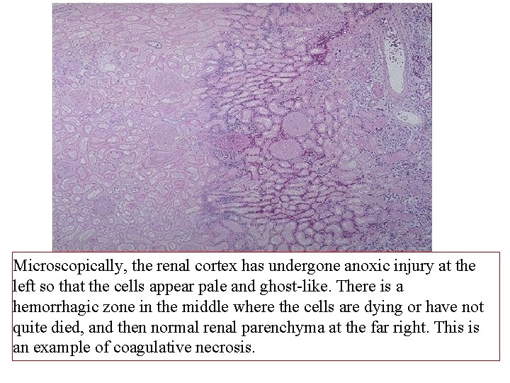 Microscopically, the renal cortex has undergone anoxic injury at the left so that the