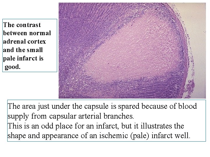 The contrast between normal adrenal cortex and the small pale infarct is good. The