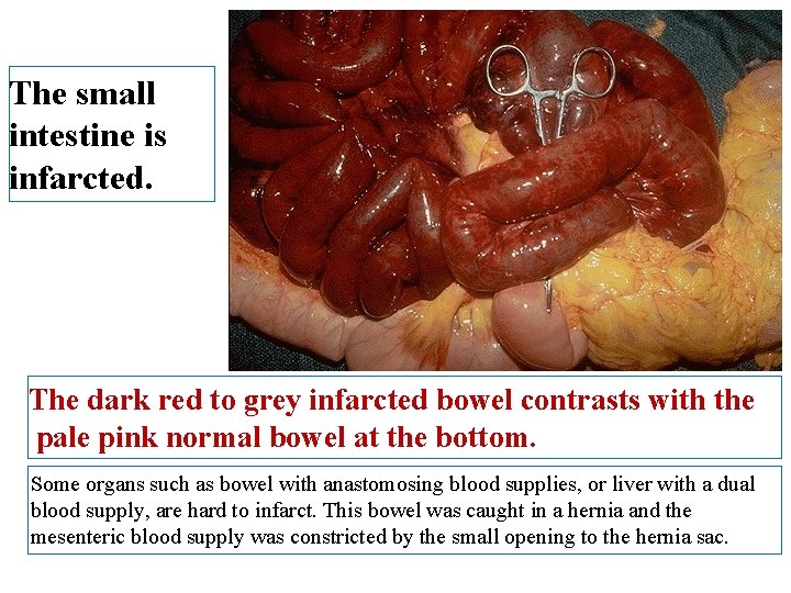 The small intestine is infarcted. The dark red to grey infarcted bowel contrasts with