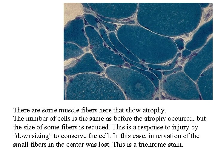 There are some muscle fibers here that show atrophy. The number of cells is