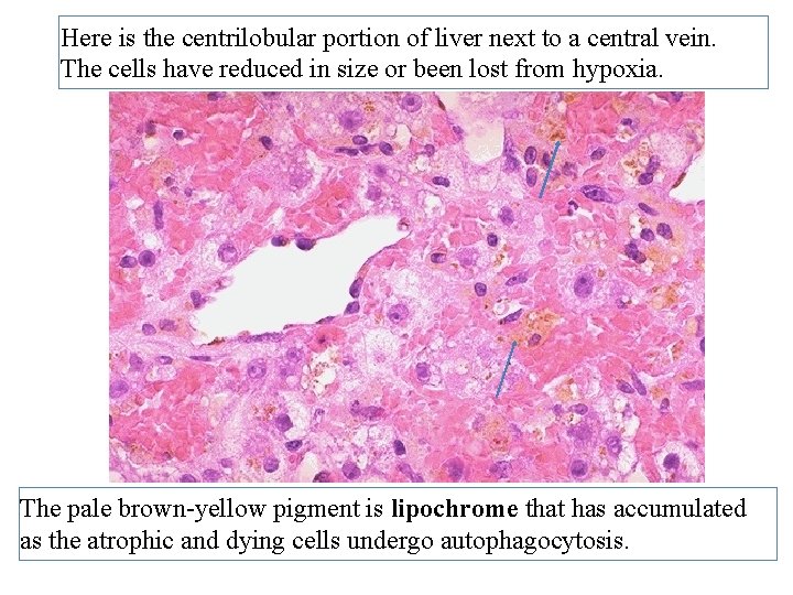 Here is the centrilobular portion of liver next to a central vein. The cells