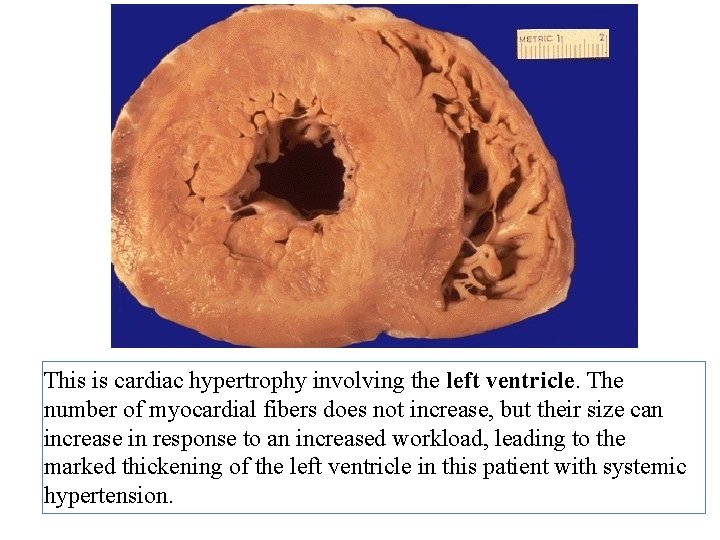 This is cardiac hypertrophy involving the left ventricle. The number of myocardial fibers does