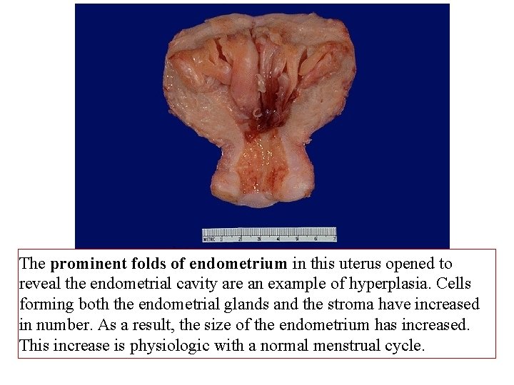 The prominent folds of endometrium in this uterus opened to reveal the endometrial cavity
