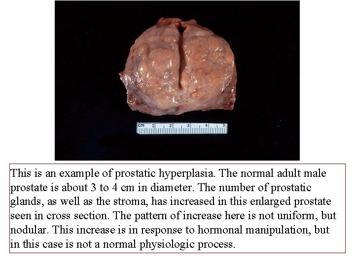 This is an example of prostatic hyperplasia. The normal adult male prostate is about