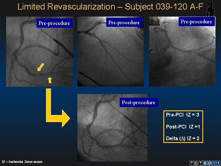 Limited Revascularization – Subject 039 -120 A-F Pre-procedure Post-procedure Pre-PCI IZ = 3 Post-PCI