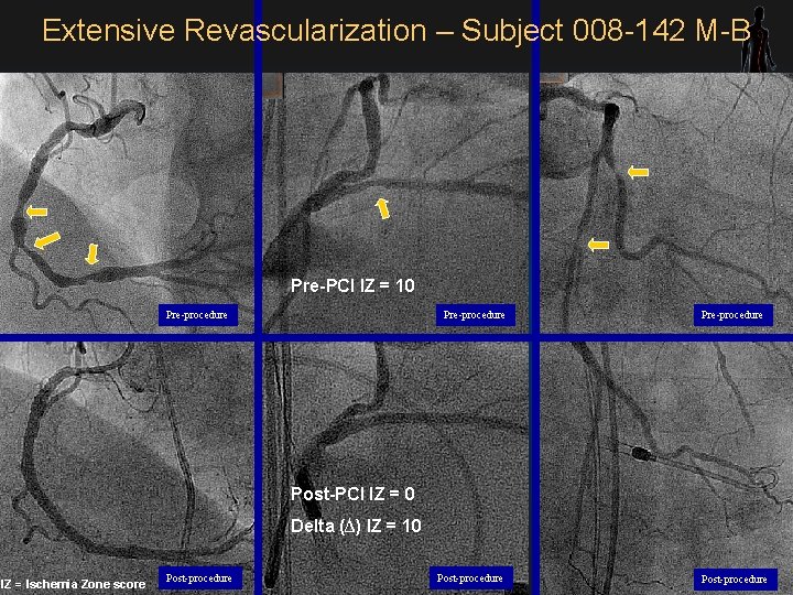 Extensive Revascularization – Subject 008 -142 M-B Pre-PCI IZ = 10 Pre-procedure Post-PCI IZ