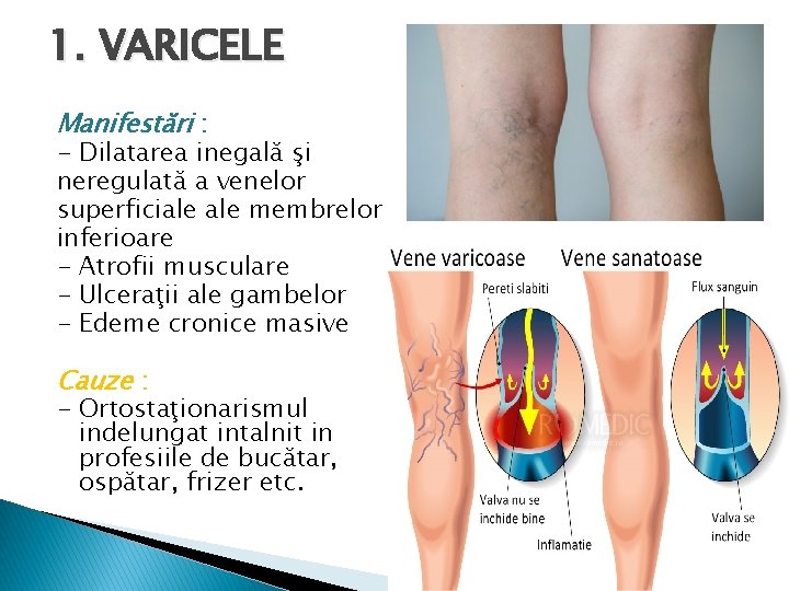  1. VARICELE Manifestări : - Dilatarea inegală şi neregulată a venelor superficiale membrelor