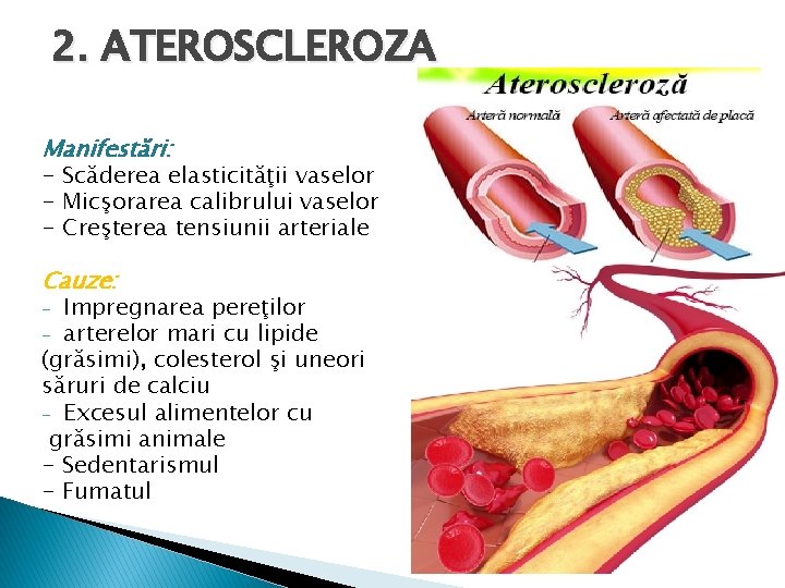 2. ATEROSCLEROZA Manifestări: - Scăderea elasticităţii vaselor - Micşorarea calibrului vaselor - Creşterea tensiunii