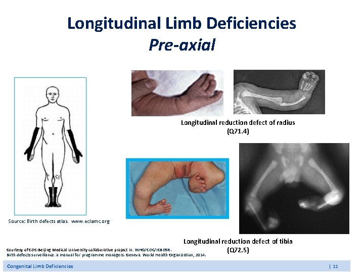 Longitudinal Limb Deficiencies Pre-axial Longitudinal reduction defect of radius (Q 71. 4) Source: Birth