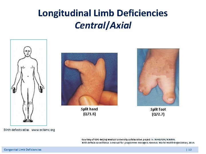 Longitudinal Limb Deficiencies Central/Axial Split hand (Q 71. 6) Split foot (Q 72. 7) Longitudinal Limb Deficiencies Central/Axial Split hand (Q 71. 6) Split foot (Q 72. 7)