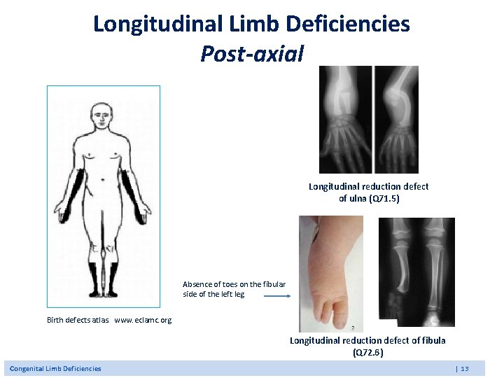 Longitudinal Limb Deficiencies Post-axial Longitudinal reduction defect of ulna (Q 71. 5) Absence of