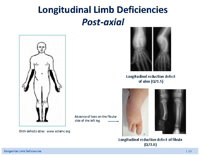 Longitudinal Limb Deficiencies Post-axial Longitudinal reduction defect of ulna (Q 71. 5) Absence of Longitudinal Limb Deficiencies Post-axial Longitudinal reduction defect of ulna (Q 71. 5) Absence of