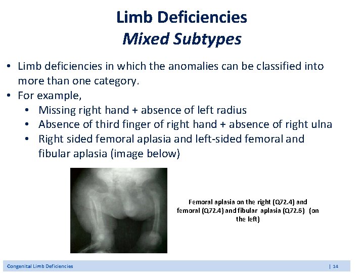 Limb Deficiencies Mixed Subtypes • Limb deficiencies in which the anomalies can be classified