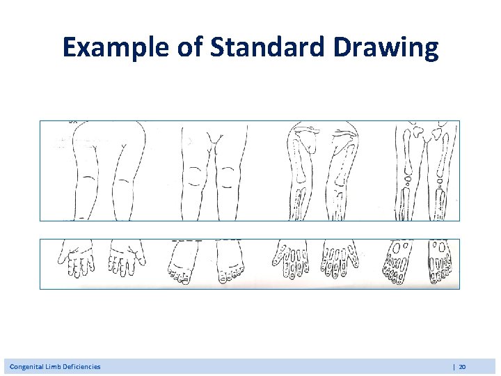 Example of Standard Drawing Congenital Limb Deficiencies | 20 