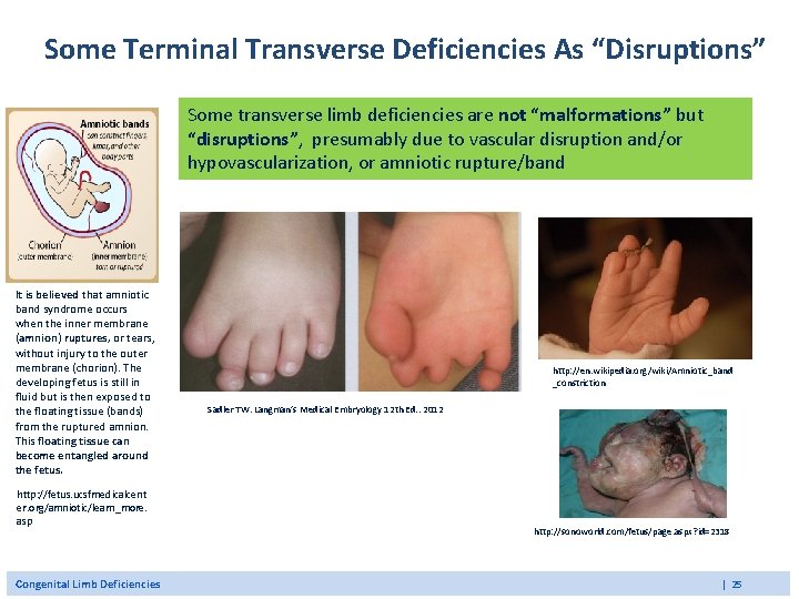 Some Terminal Transverse Deficiencies As “Disruptions” Some transverse limb deficiencies are not “malformations” but Some Terminal Transverse Deficiencies As “Disruptions” Some transverse limb deficiencies are not “malformations” but