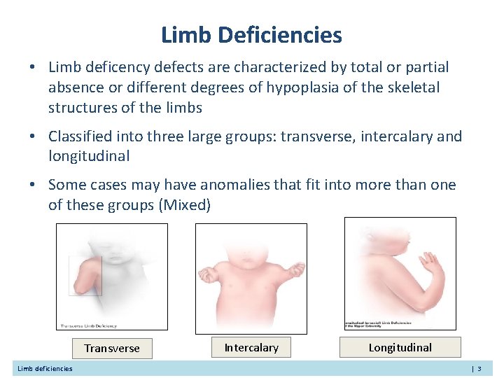 Limb Deficiencies • Limb deficency defects are characterized by total or partial absence or