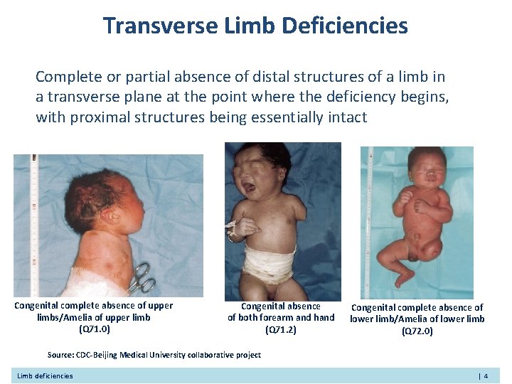 Transverse Limb Deficiencies Complete or partial absence of distal structures of a limb in Transverse Limb Deficiencies Complete or partial absence of distal structures of a limb in