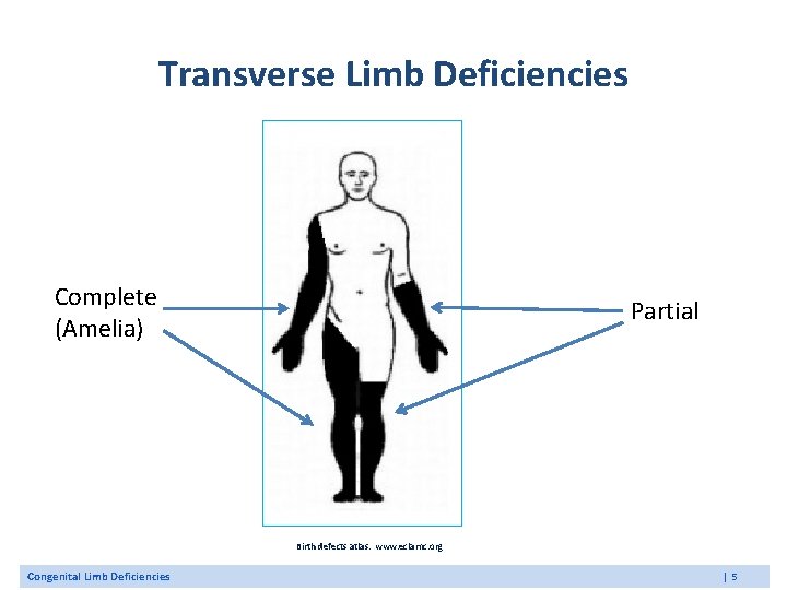 Transverse Limb Deficiencies Complete (Amelia) Partial Birth defects atlas. www. eclamc. org Congenital Limb Transverse Limb Deficiencies Complete (Amelia) Partial Birth defects atlas. www. eclamc. org Congenital Limb