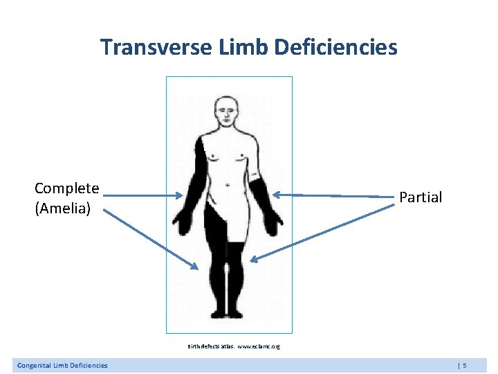 Transverse Limb Deficiencies Complete (Amelia) Partial Birth defects atlas. www. eclamc. org Congenital Limb