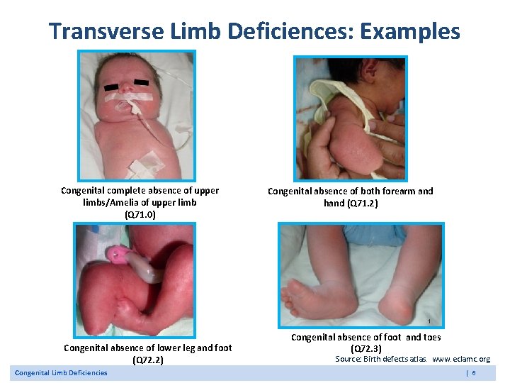 Transverse Limb Deficiences: Examples Congenital complete absence of upper limbs/Amelia of upper limb (Q