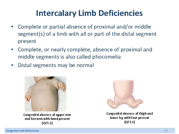 Intercalary Limb Deficiencies • Complete or partial absence of proximal and/or middle segment(s) of