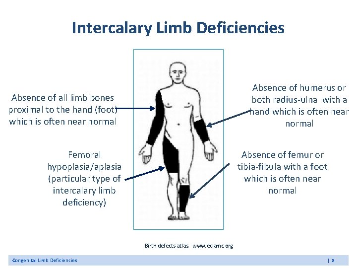 Intercalary Limb Deficiencies Absence of humerus or both radius-ulna with a hand which is Intercalary Limb Deficiencies Absence of humerus or both radius-ulna with a hand which is