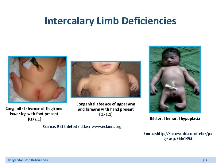 Intercalary Limb Deficiencies Congenital absence of thigh and lower leg with foot present (Q Intercalary Limb Deficiencies Congenital absence of thigh and lower leg with foot present (Q