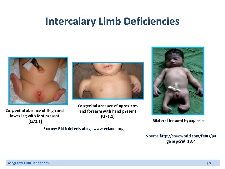 Intercalary Limb Deficiencies Congenital absence of thigh and lower leg with foot present (Q