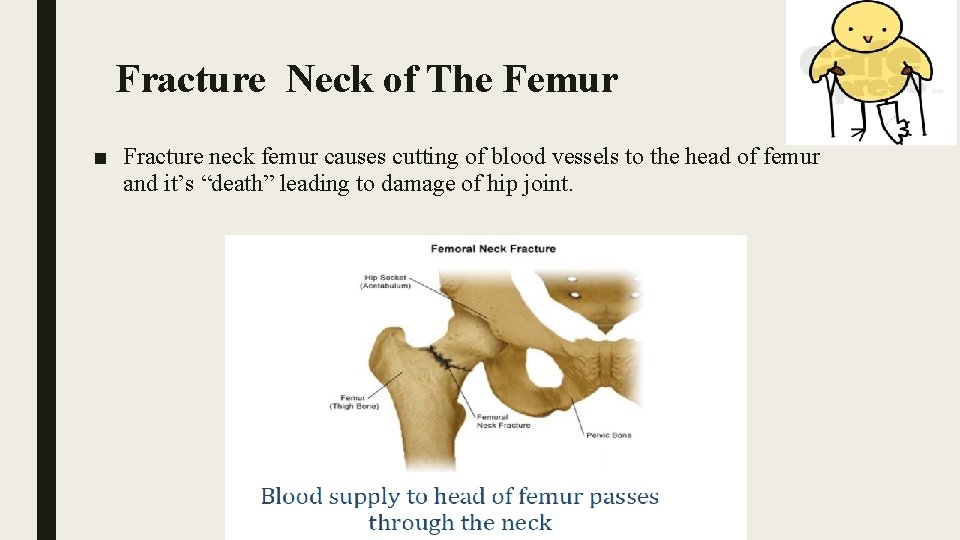 Fracture Neck of The Femur ■ Fracture neck femur causes cutting of blood vessels