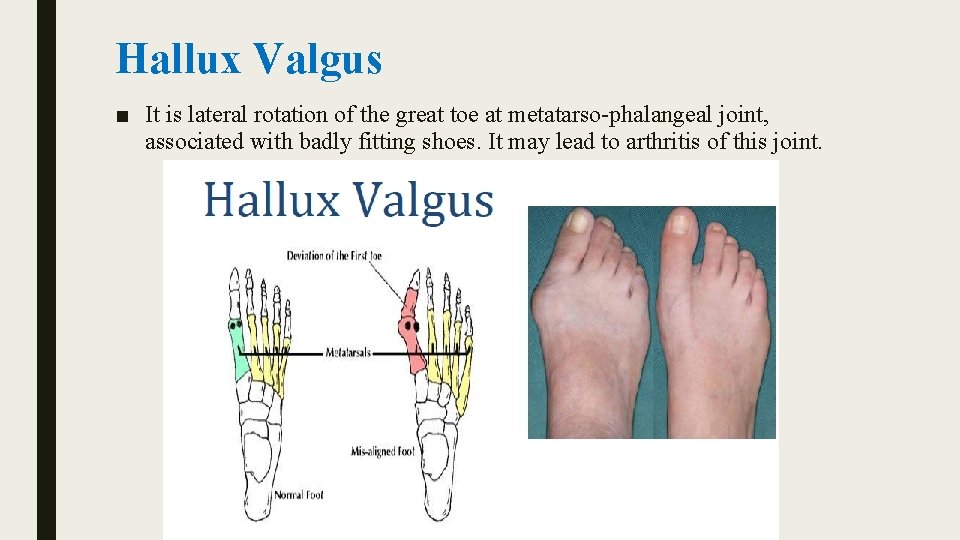 Hallux Valgus ■ It is lateral rotation of the great toe at metatarso-phalangeal joint,