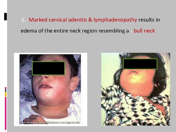 2. Marked cervical adenitis & lymphadenopathy results in edema of the entire neck region
