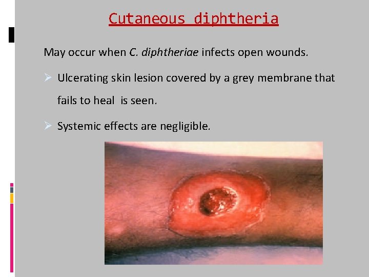 Cutaneous diphtheria May occur when C. diphtheriae infects open wounds. Ø Ulcerating skin lesion