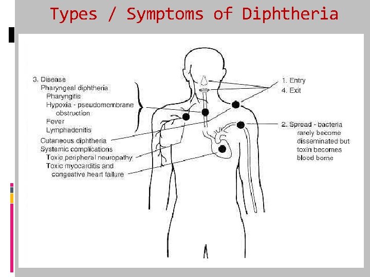 Types / Symptoms of Diphtheria 