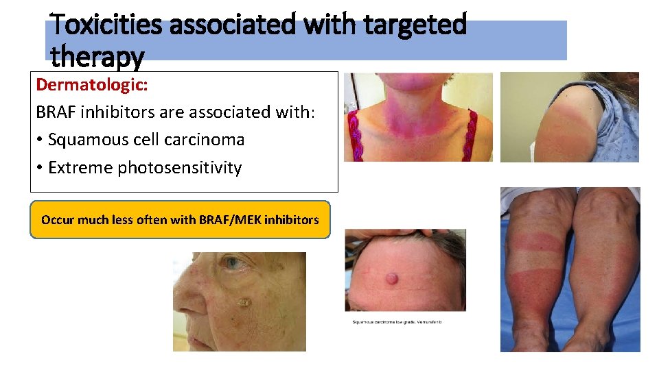 Toxicities associated with targeted therapy Dermatologic: BRAF inhibitors are associated with: • Squamous cell