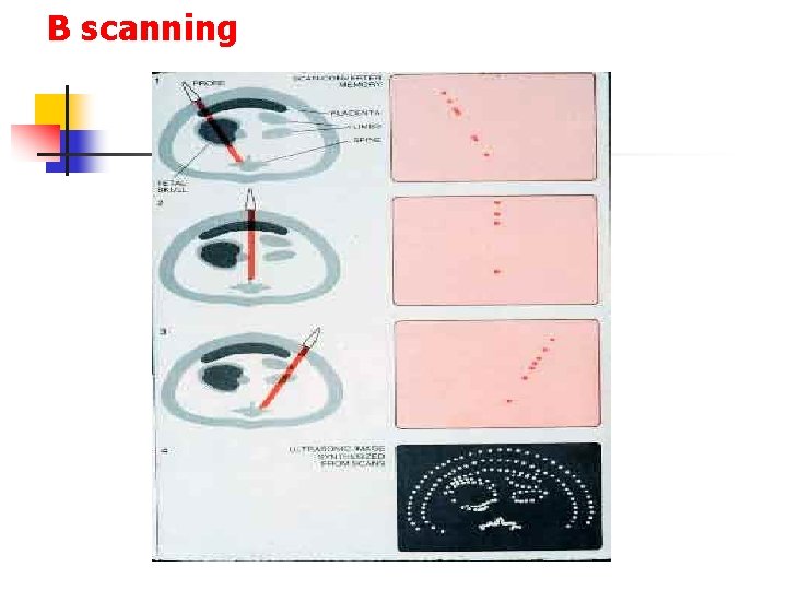 B scanning 