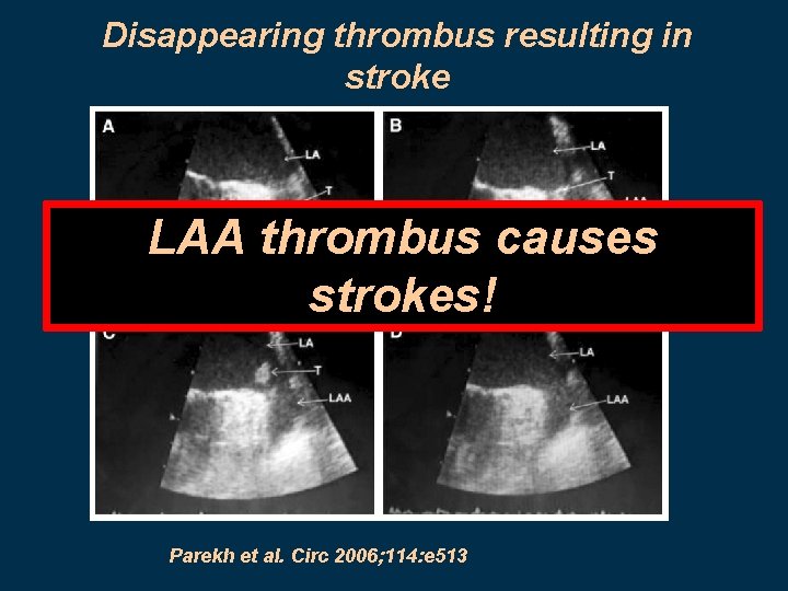 Disappearing thrombus resulting in stroke LAA thrombus causes strokes! Parekh et al. Circ 2006;